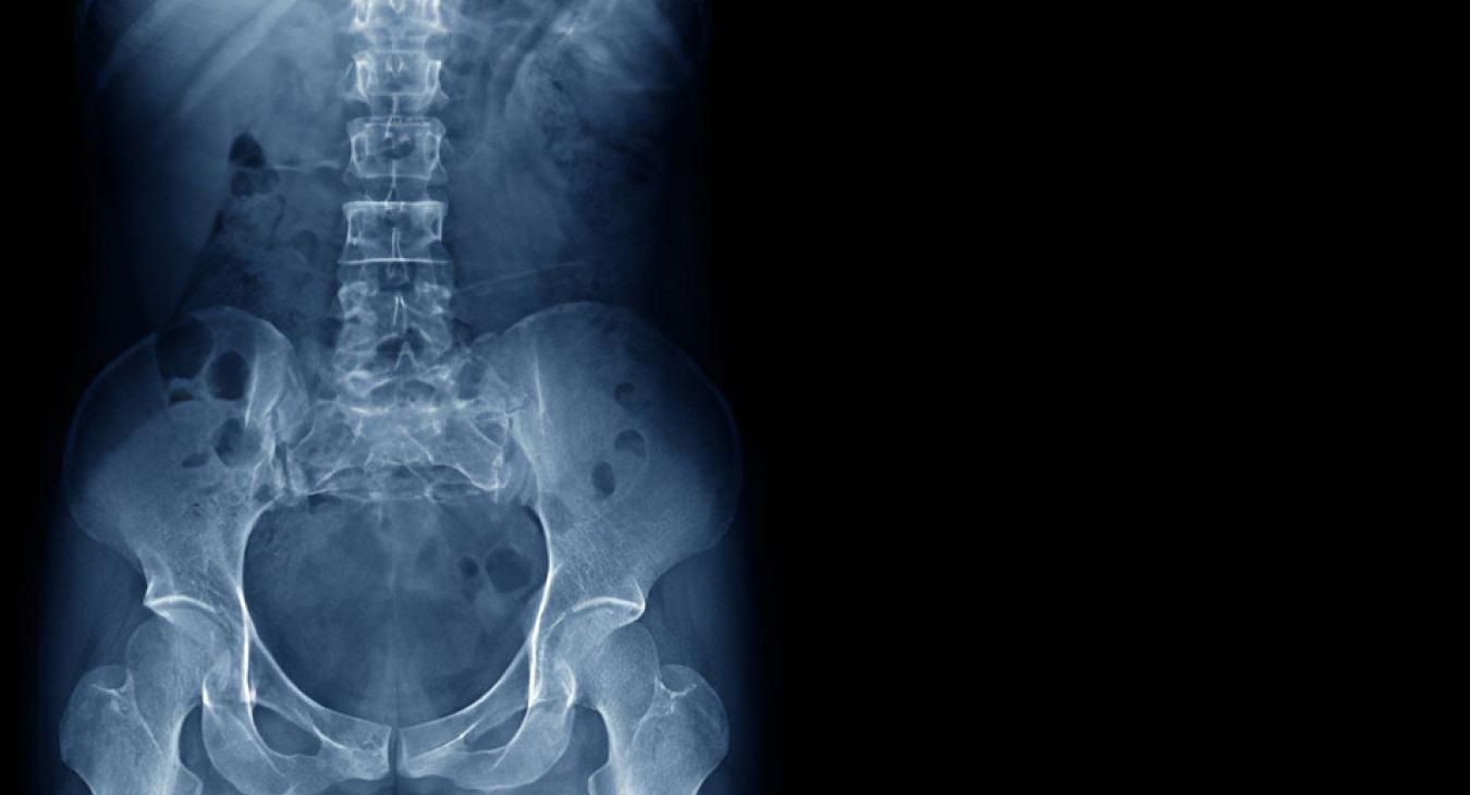 A várólista nem igazán csökken, viszont a csípőműtétek árai a magánegészségügyben nőnek