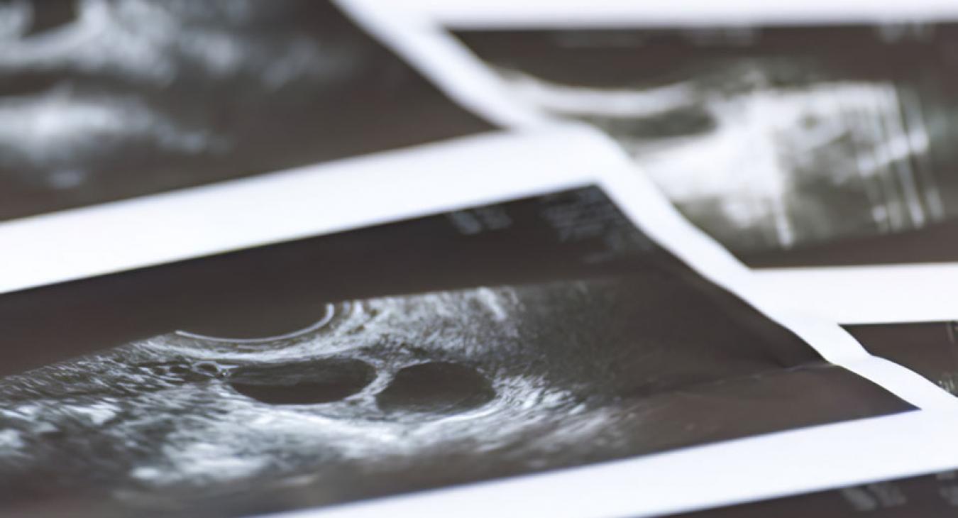 A magyarok 72 százaléka támogatja a legális abortuszt 