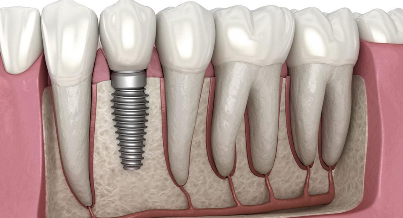 Semmelweis: a dohánytermékek közül a füstmentesek károsítják leginkább a fogimplantátumot